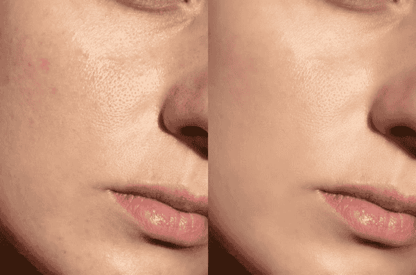 Close-up before and after image showing exfoliated skin with smoother texture, minimized pores, and improved skin clarity.