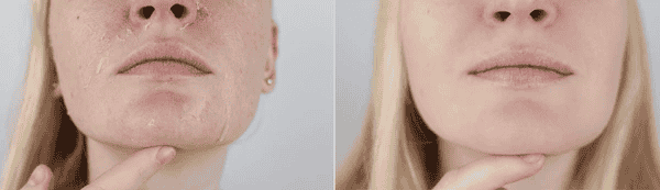 Before and after image showing hydrated skin with improved moisture levels, softness, and healthy glow.